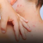 Brasil soma 37 casos de sarampo neste ano e reforça vacinação em meio à alta no continente